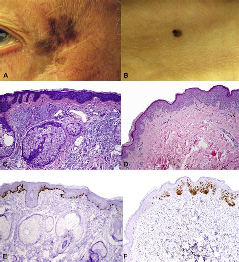 Adequacy Of 5 Mm Surgical Excision Margins For Non Lentiginous Melanoma