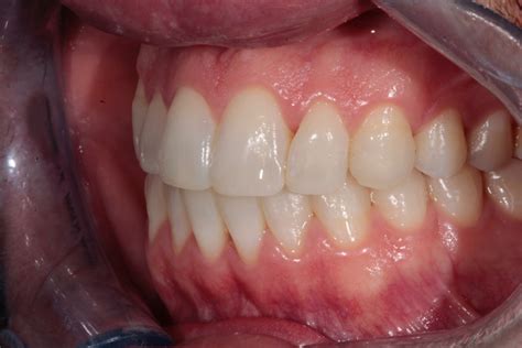 Orthodontics In General Practice Dental Careers Guide Dental