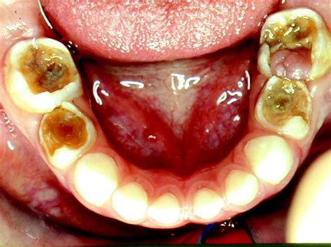 Oral Cavity Teeth