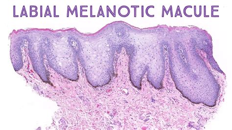 Labial Melanotic Macule Brown Spot On Lip Stony Brook Case 1