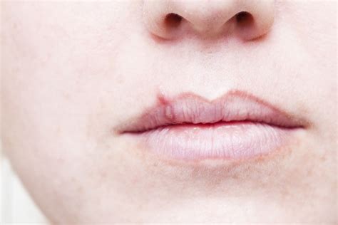 Cold Sores Or Fever Blisters In Children