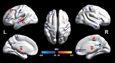 Autistic And Non Autistic Brain Differences Isolated For First Time