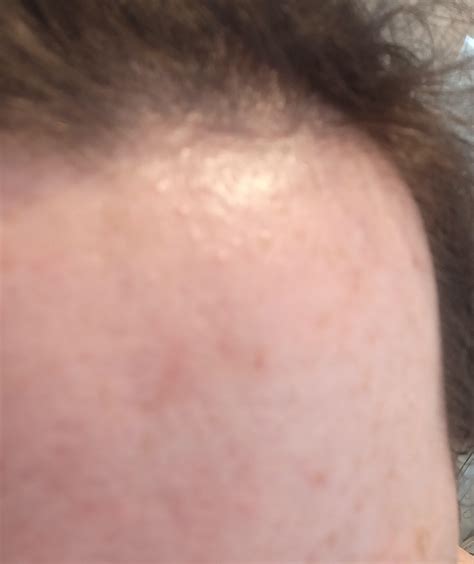 Skin Concerns Help With Forehead Bumps And Scars Rskincareaddiction