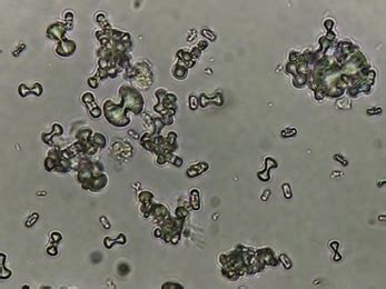 Calcium oxalate stones are caused by too much oxalate in the urine. Calcium oxalate crystalluria points to primary ...