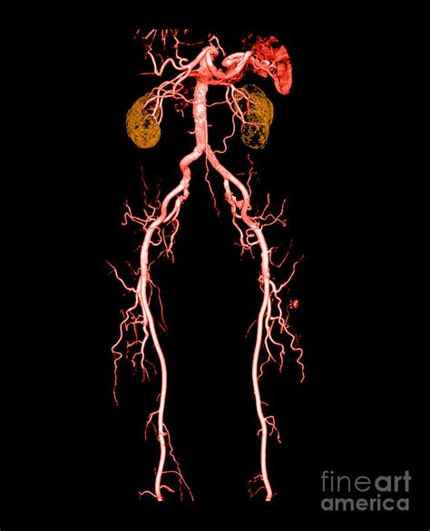 Ct Angiogram Of Abdomen And Legs Photograph By Medical Body Scans