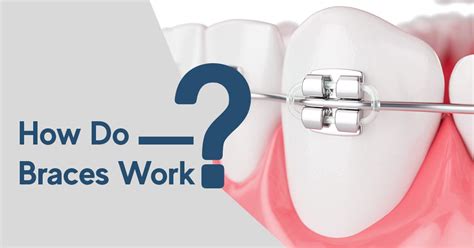 How Do Braces Work Types Materials And Time To Start Working