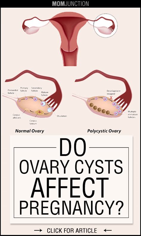 Can Ovarian Cysts Prevent Pregnancy