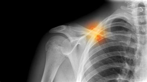 Whats The Difference Between A Fracture And A Break Bone Fracture