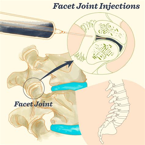 Facet Joint Injections Southwest Sports And Spine