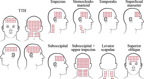 Headache Muscle Tension Trigger Points And Referred Pain Arendt