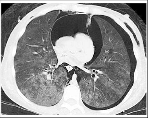 Ct Showing Subcutaneous Emphysema Bilateral Pneumothorax Tension