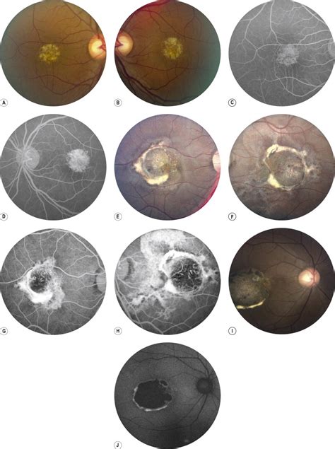 Heredodystrophic Disorders Affecting The Pigment Epithelium And Retina