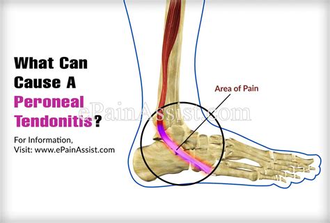 What Can Cause A Peroneal Tendonitis 38880 Hot Sex Picture