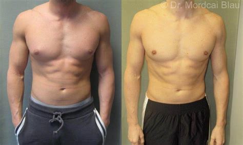 Bodybuilder Gynecomastia Before And After Photos Gynecomastia Usa