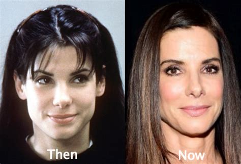 Sandra Bullock Plastic Surgery Before And After Photos