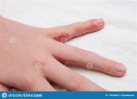 Child Hand Witn Eczema Atopic Dermatitis Between Fingers Stock Image