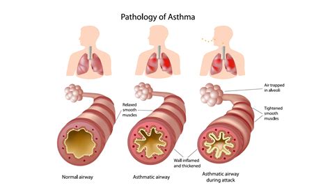 Los Tipos De Asma Caracter Sticas Y Efectos