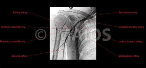 Arteriography Angiogram Of The Axillary Artery And His Branches All