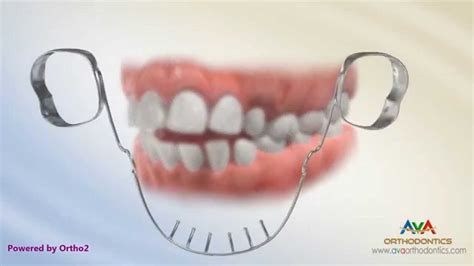 Orthodontics Treatment For Openbite Lower Tongue Crib Appliance Youtube