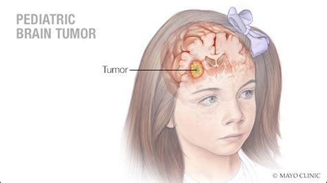 Ask The Mayo Mom Tumor Type Grade Determine Treatment For Pediatric