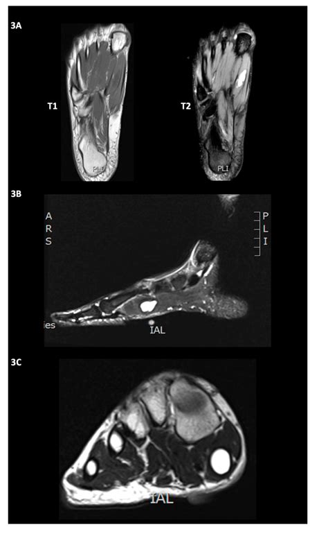 Foot Muscles Mri Mri Scan London Sports Orthopaedics Hip Pelvis