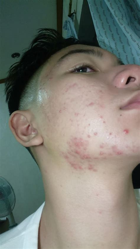 3 Ways To Get Rid Of Pitted Skin On Your Jawline Justinboey