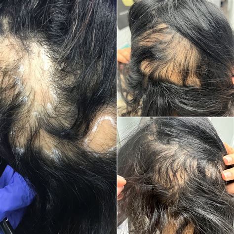 Alopecia Areata Hair Loss Prf And Placenta One Treatment Results Ny Nj