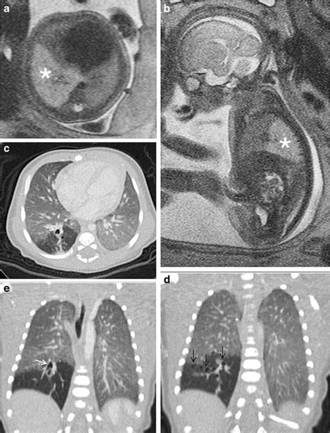 Imaging Findings Of Bronchial Atresia In Fetuses Neonates And Infants