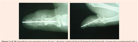 Figure 2 From Management Of Nonunion In Proximal Phalanx Thumb