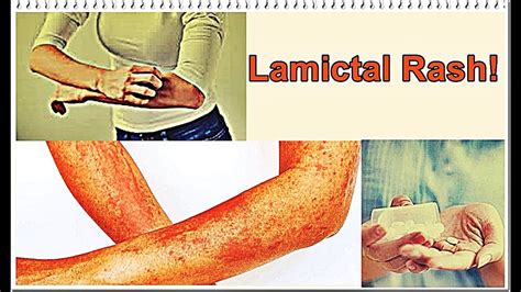 Lamictal Rash Symptoms Treatment Youtube