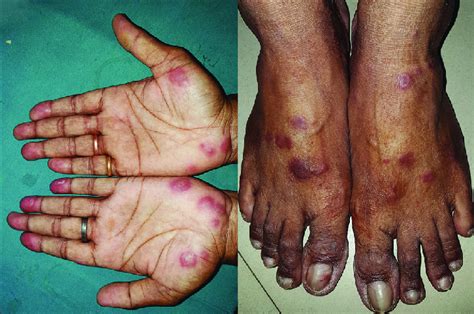 Multiple Erythematous To Violaceous Plaques Symmetrically Distributed