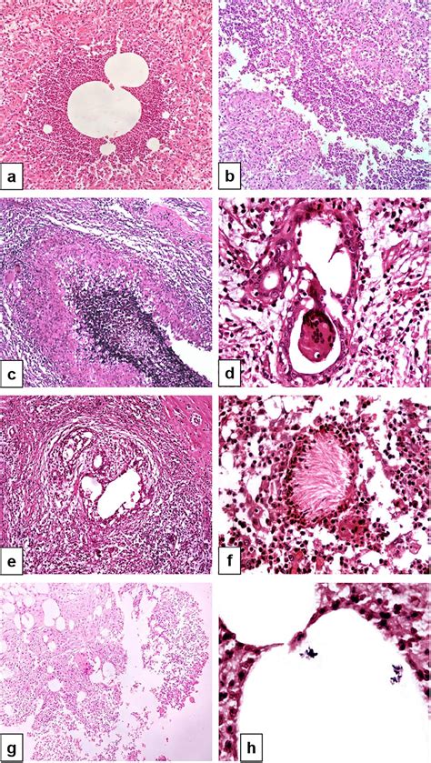 Cystic Neutrophilic Granulomatous Mastitis A Clinicopathological Study