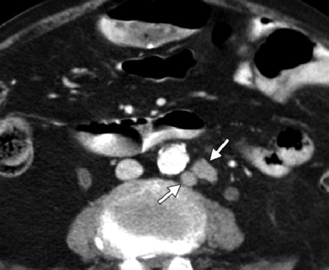Axial Contrast Enhanced Ct Image Obtained In A Patient With Cancer Of