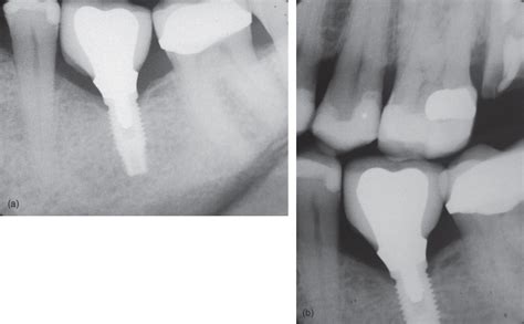 12 Radiographic Imaging In Implant Dentistry Pocket Dentistry