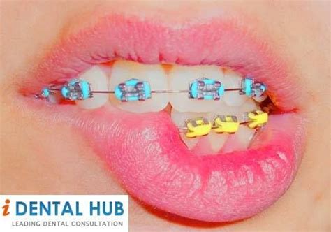 125 best images about braces on pinterest mouths getting braces and brushing