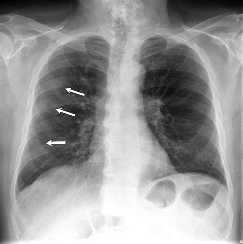 Maybe you would like to learn more about one of these? Pneumothorax and pneumomediastinum: a rare complication in ...