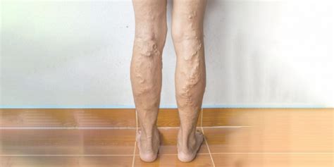 What Happens If Varicose Veins Are Not Treated Pristyn Care