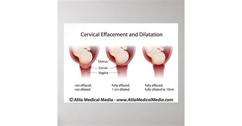 Cervical Effacement And Dilatation Chart Poster Zazzle