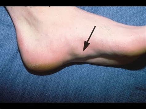 It affects runners and other athletes, but it can also occur in people who are less active. What causes a lump on the bottom of your foot? - Quora