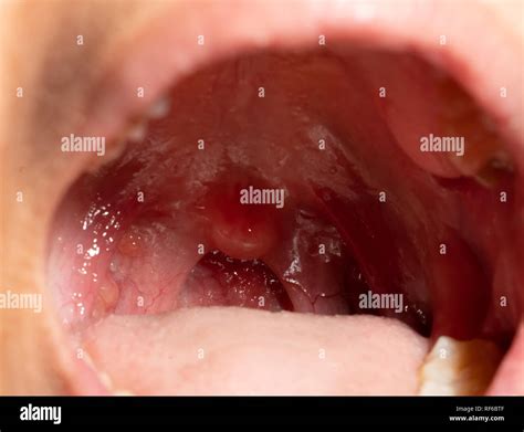 Normal Roof Of Mouth Images Torus Palatinus Symptoms Diagnosis Causes