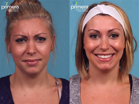 Botox® Cosmetic Before And After Pictures Case 388 Orlando Florida