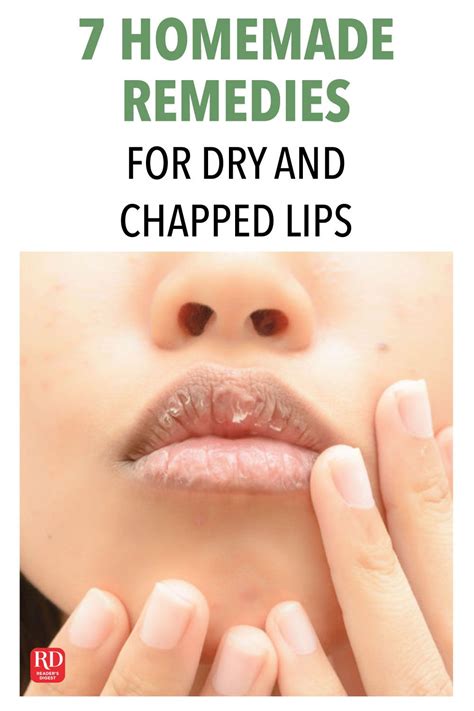 7 Homemade Remedies For Dry And Chapped Lips Dry Lips Remedy Chapped Lips Remedy Dry Cracked