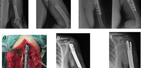 Limb Salvage Surgery With Joint Preservation For Malignant Humeral Bone