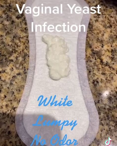 White Vaginal Discharge Yeast Infection