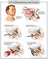Pictures of 4 Level Cervical Fusion Recovery