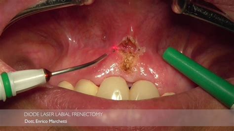 Laserfrenectomy Sunrise Orthodontics