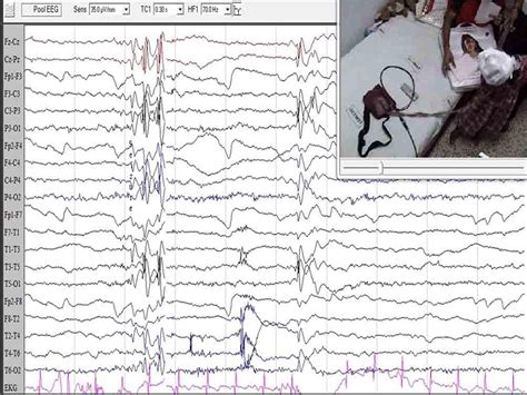 Atonic Variant Of Benign Childhood Epilepsy With Centrotemporal Spikes
