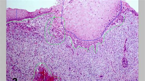 Histology Cancer Youtube