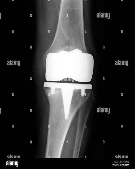 Prosthetic Knee Joint Frontal X Ray Of A Patient With A Prosthetic