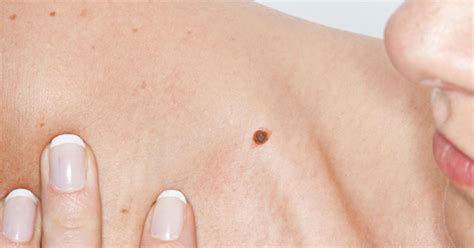 Moles May Be Sign Of Higher Breast Cancer Risk Cbs News
